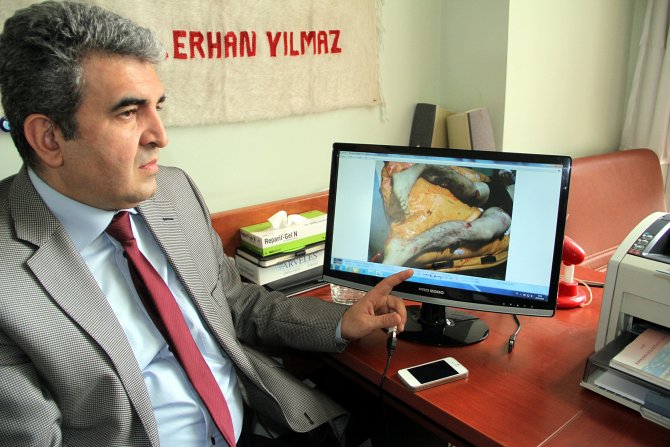 Bacaklarını Kaybetme Tehlikesi Geçiren Genç Yeniden Adım Attı