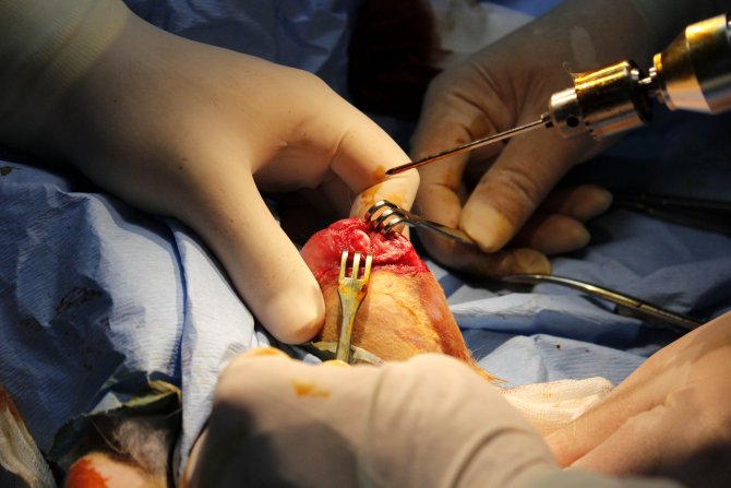 MKÜ'den vücutta eriyebilen implant