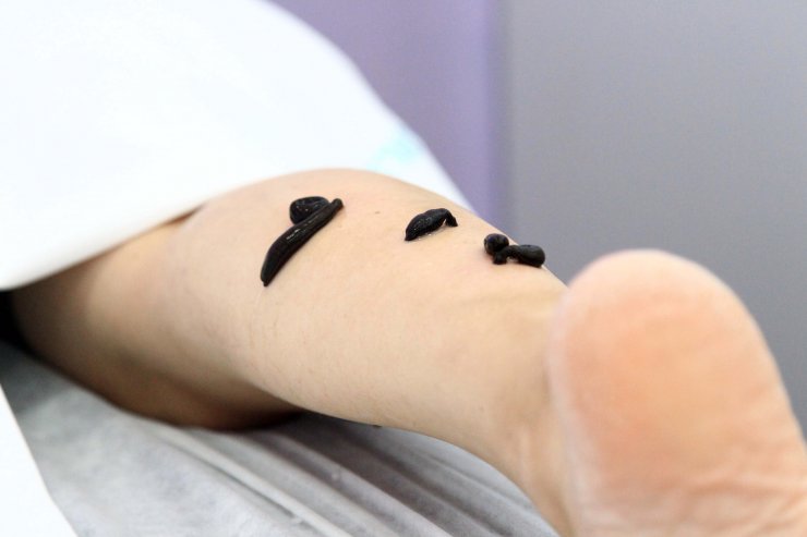 Doktorların elinden sülük tedavisi