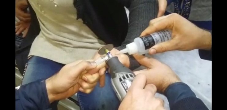 Şanlıurfa’da genç kadının parmağına sıkışan yüzük kesilerek çıkarıldı
