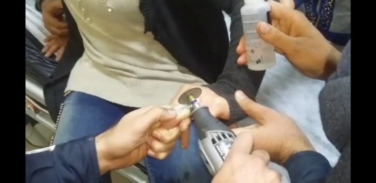 Şanlıurfa’da genç kadının parmağına sıkışan yüzük kesilerek çıkarıldı