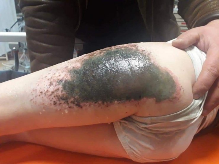 Afyonkarahisar’da öğrencilerin vücutlarındaki yanıkların sebebi belli oldu