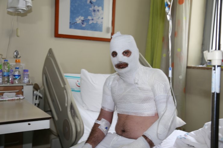 Tinerle temizlik yaparken sigara yakınca kıyafeti alev aldı