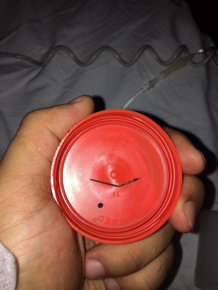 Doğum günü pastası yerken boğazına toplu iğne saplandı