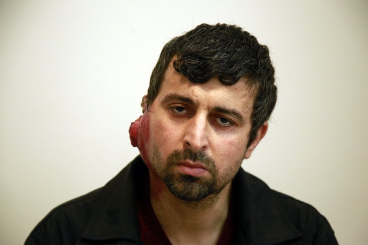 Kulağındaki tümörden kurtulmak isteyen Hataylı çiftçiye yardım eli uzandı